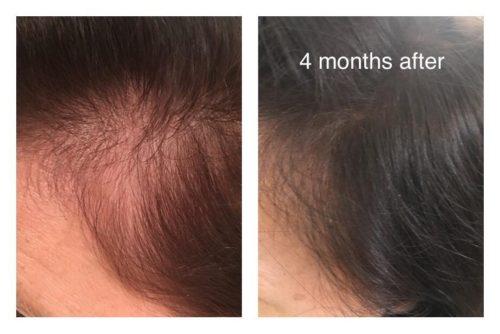 Shelure Hair Regrowth Treatment Advanced photo review